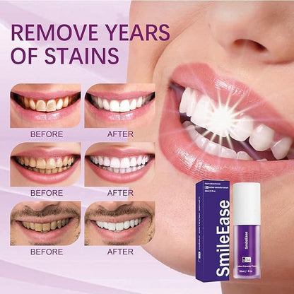 Purple Teeth Whitening